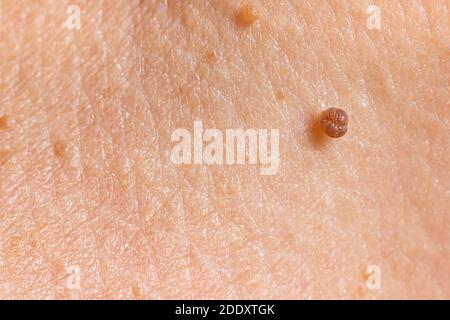 Papillom auf der menschlichen Haut - gutartiger Tumor in Form von Maulwurf, Nevus, Tumor. Papillomatose Stockfoto