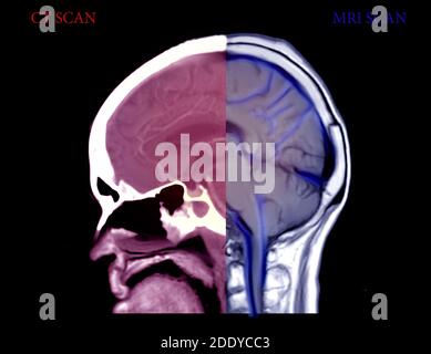 Vergleichen Sie CT Brain und MRI Brain Sagittal Ansicht . Medizinisches Hintergrundkonzept. Stockfoto