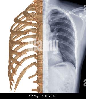 Vergleichen Sie CT Thorax 3D-Rendering und Thorax-Röntgen . Stockfoto