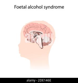 Fetales Alkoholsyndrom, Illustration Stockfoto