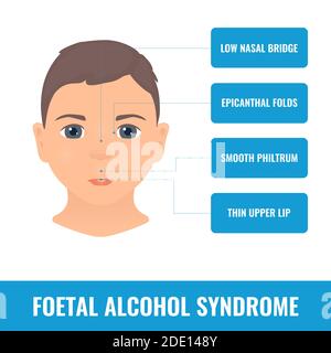 Fetales Alkoholsyndrom, Illustration Stockfoto