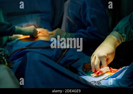 Betrieb chirurgische Behandlung am Bein mit verschiedenen chirurgischen Instrumente während der Operation im Krankenhaus. Stockfoto