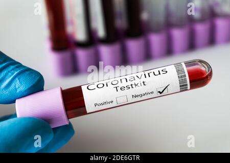 Draufsicht auf das Reagenzglas mit Blutprobe negativ für den Ausbruch des neuen Coronavirus. Covid-19 Pandemie. Stockfoto