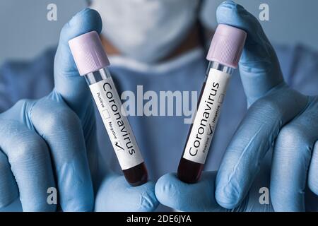 COVID-19 Test und Laborprobe von Blutuntersuchungen zur Diagnose neuer Corona-Virus-Infektion. Positive und negative Ergebnisse. Coronavirus-Konzept. Stockfoto