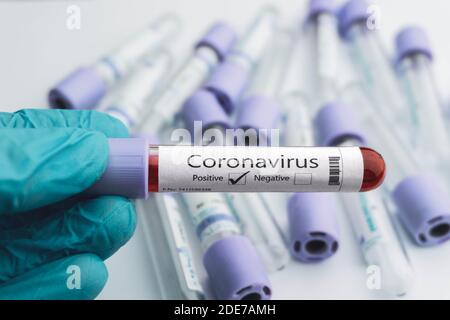 Positiver COVID-19-Test und Laborprobe von Blutuntersuchungen zur Diagnose neues Coronavirus-Outbreaking-Konzept. Stockfoto