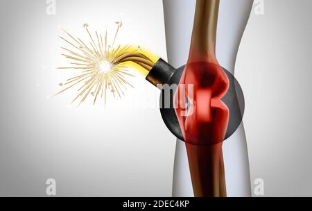 Schmerzhafte Knieschmerzen und schmerzhafte Gelenke als medizinische Illustration eines menschlichen Skeletts, das eine Sportverletzung oder einen körperlichen Unfall zeigt. Stockfoto