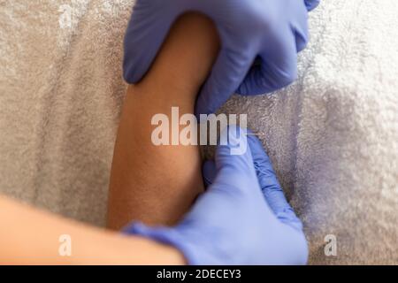 Physiotherapeut, der Behandlung mit trockener Nadelakupunktur dem Patienten in gibt Die Hände Stockfoto