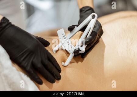 Bestimmung der Menge an Talg auf männlichen Bauch mit medizinischen Caliper, Nahaufnahme Stockfoto