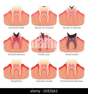 Zahnstörungen Set, flache Vektorgrafik. Gesunde und ungesunde Zähne. Zahnprobleme und Krankheiten. Stock Vektor