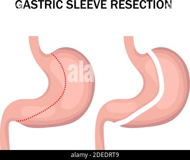 Infografik zur Magenärmelresektion. Magen-Reduktion Chirurgie zur Gewichtsabnahme. Medizinkonzept. Vektorgrafik Stock Vektor