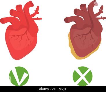 Gesundes Herz und ungesunde Herz fettige Infografiken. Menschliches Organ, Medizinkonzept. Vektorgrafik Stock Vektor