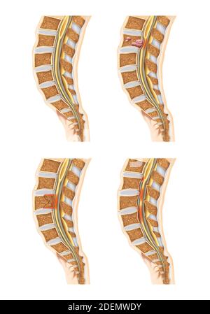 Anatomie der Wirbelsäulen- und Lendenwirbelscheibe Stockfoto