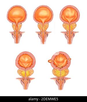 Anatomische Darstellung der Prostataerkrankung Stockfoto