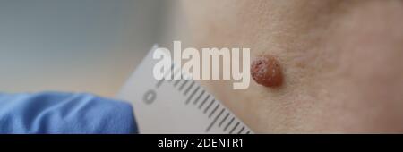 Arzt Dermatologe Messung pigmentierten Nevus auf dem Gesicht des Patienten mit Lineal In der Klinik Nahaufnahme Stockfoto