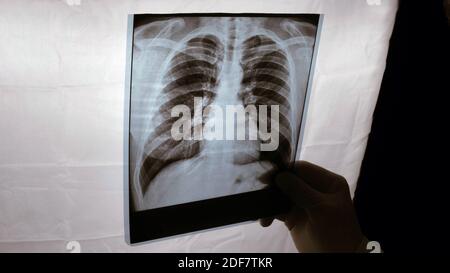 Röntgenaufnahme der Lunge zeigen durch, ein Bild der Lunge, der Arzt macht eine Röntgenanalyse der Lunge einer Person. Stockfoto