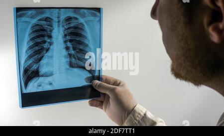 Röntgenaufnahme der Lunge isoliert auf weißem Hintergrund. Ein Arzt untersucht eine Röntgenaufnahme der Lunge. Stockfoto