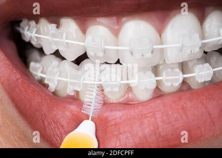 Weibliche Reinigung Zahnhalterungen Im Mund Mit Zahnbürste Stockfoto