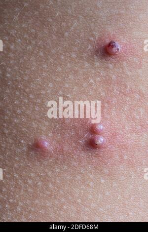 Molluskum contagiosum auf der Haut eines Kindes. Stockfoto