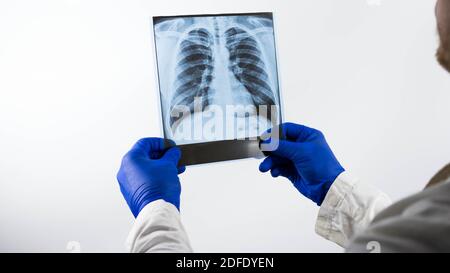 Röntgenaufnahme der menschlichen Lunge auf weißem Hintergrund im Hände eines Arztes, Röntgendiffraktion, Demonstration der Lunge in der Bild,der Patient diagnostiziert Stockfoto
