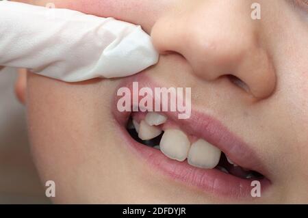 Kieferorthopäde untersucht Jungen Mund. Der Zahn wächst an der falschen Stelle Stockfoto