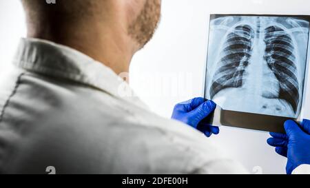 Röntgenaufnahme der menschlichen Lunge in der Hand eines Arztes. Der Arzt macht eine Analyse einer Momentaufnahme der Lunge, die Diagnose einer Lungenentzündung auf einem Röntgenbild. Stockfoto