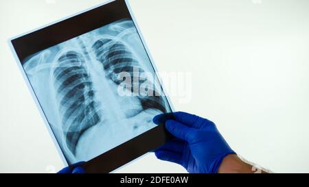 Röntgenaufnahme der menschlichen Lunge in der Hand eines Arztes. Stockfoto