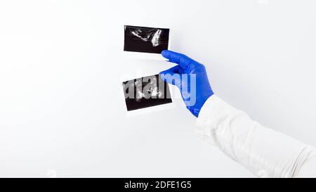 Der Arzt hält einen Ultraschall der Prostata in der Hand, eine Momentaufnahme der Prostata in den Händen eines Arztes auf weißem Hintergrund. Stockfoto