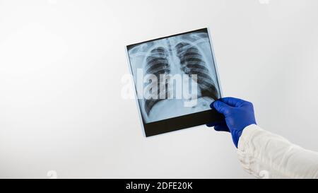 Thorax-Röntgen, Arzt und Lunge Röntgen, close-up.A Arzt in einem Krankenhaus diagnostiziert eine Lungenerkrankung. Stockfoto
