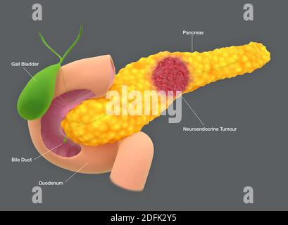 Pankreas neuroendokriner Tumor, Illustration Stockfoto