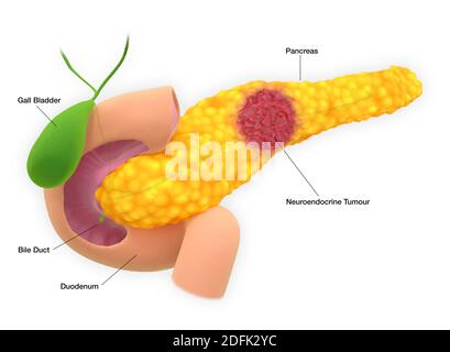 Pankreas neuroendokriner Tumor, Illustration Stockfoto