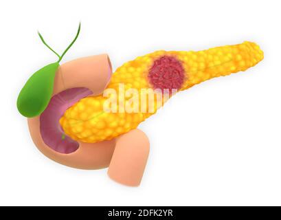 Pankreas neuroendokriner Tumor, Illustration Stockfoto