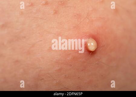 Nahaufnahme Bild von Pickel mit Eiter auf der menschlichen Haut, hormonelle Störung