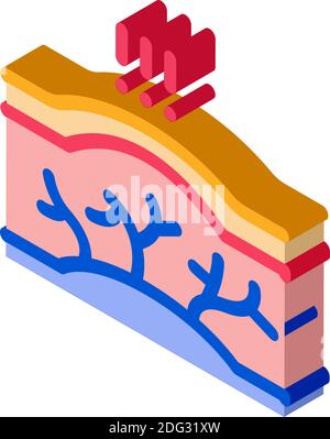 Krampfadern Krankheit isometrische Symbol Vektor Illustration Stock Vektor