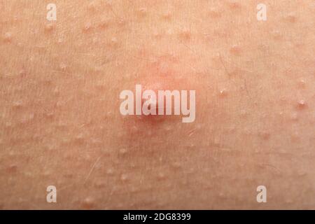 Nahaufnahme Bild von Pickel mit Eiter auf der menschlichen Haut, hormonelle Störung