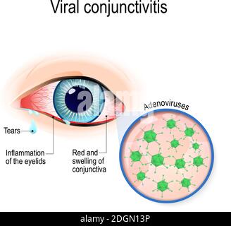 Viruskonjunktivitis. Adenoviren sind die Ursache für eine virale Konjunktivitis Stock Vektor