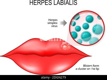 Herpes labialis (Blasen) auf der Lippe. Ursache ist Herpes simplex Virus (unter einer Lupe). Vektordiagramm für den medizinischen Einsatz Stock Vektor