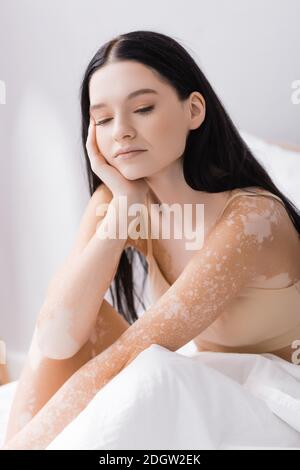 Junge Brünette Frau mit Vitiligo im Schlafzimmer Stockfoto