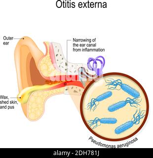 Das Ohr des Schwimmers. Otitis externa ist eine Entzündung des Gehörgangs. Bakterielle Infektionen Krankheit. Nahaufnahme von Pseudomonas aeruginosa. Menschliche Anatomie Stock Vektor