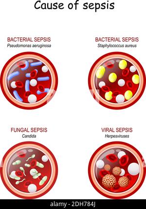 Sepsis. Nahaufnahme Des Blutgefquerschnitts Mit Bakterieller
