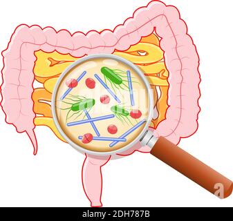 Darmflora. Menschlicher Dünndarm, Dickdarm und Lupe. Nahaufnahme von schlechten Bakterien: Clostridium perfringens, Enterococcus fecalis Stock Vektor