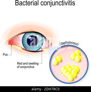 Bakterielle Konjunktivitis. Auge mit Konjunktivitis und Bakterien, die es verursachen. Staphylokokken Stock Vektor