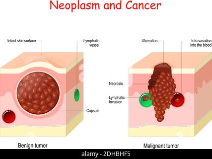Krebs und Neoplasma. Vergleich und Unterschied zwischen bösartigen und gutartigen Tumoren. Gutartiger Tumor hat eine Kapsel. Zellen des malignen Tumors haben Nekrose Stock Vektor