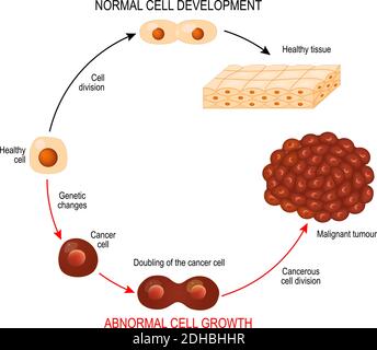 Krebszelle und normale Zelle. Gesundes Gewebe und bösartiger Tumor. Abbildung zeigt Krebs Krankheitsentwicklung. Vektordiagramm für Ihr Design Stock Vektor