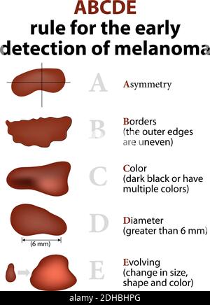 ABCDE-Regel für die Früherkennung von Melanomen Stock Vektor