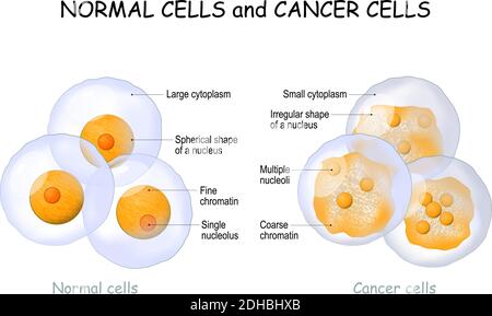 Krebszellen und normale Zellen. Vergleich und Unterschied zwischen gesundem Gewebe und Tumor. Details zu Chromatin, Zellkern und Zytoplasma. Stock Vektor
