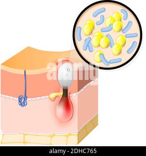 Akne vulgaris. Nahaufnahme von Bakterien, die Hautkrankheiten verursachen. Stadien der Entwicklung von Pickel. vektor-Illustration für Dermatologie, Hautpflege und medizinische Stock Vektor