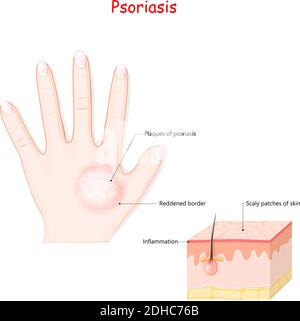 Psoriasis der menschlichen Hand. Krankheitssymptome. Querschnittsschichten der normalen Haut und Haut mit Schuppenflechte Bildung. vektor-Illustration Stock Vektor