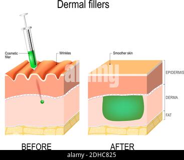 Injizierbarer kosmetischer Füllstoff. So funktioniert es. Verfahren. Vor und nach der Injektion. Stock Vektor