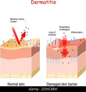 Dermatitis. Normal und Haut mit geschädigter Barriere. Schutzwirkung. Der Unterschied zwischen gesunder und trockener Haut Stock Vektor