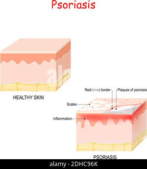 Normale Haut und Psoriasis. Anzeichen und Symptome Hauterkrankung. Stock Vektor